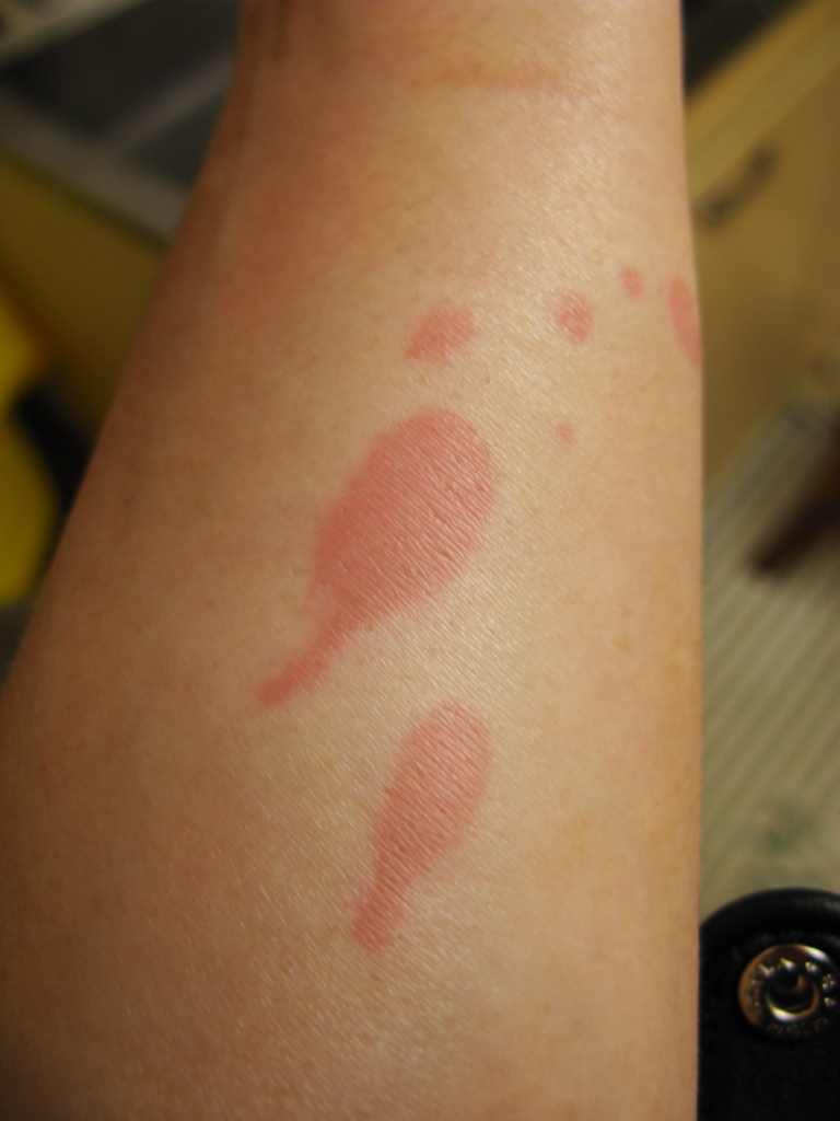 おたまじゃくし(火傷)