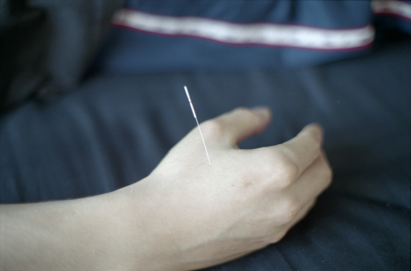 Acupuncture